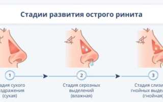 Ринит у взрослых: причины, признаки и способы лечения