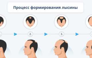 Методы борьбы с лысиной у мужчин: можно ли остановить облысение