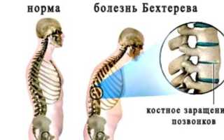 Народная медицина против болезни Бехтерева
