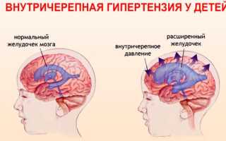 Что такое внутричерепная гипертензия, какие признаки и симптомы сопровождают синдром и как он лечится у детей?