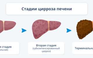 Цирроз печени: причины, симптомы и методы лечения