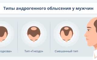 Облысение у мужчин: что нужно делать, если выпадают волосы?