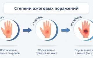 Что делать после ожога: лечение кожи и средства для заживления ран