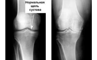 Причины, профилактика и лечение дефартроза коленного сустава