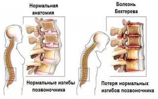 Лечение болезни Бехтерева у женщин