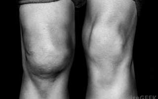 Боль и опухоль в колене