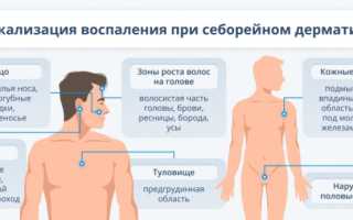 Себорейный дерматит: причины заболевания и подходы к лечению
