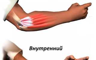 Лечение локтевого эпикондилита народной медициной