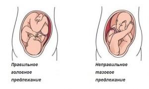 Неправильное положение плода