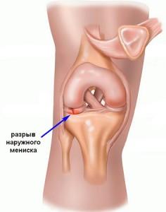Разрыв мениска