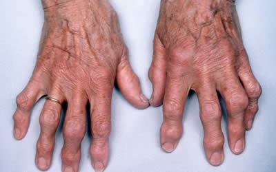 Лечение остеоартроза суставов рук