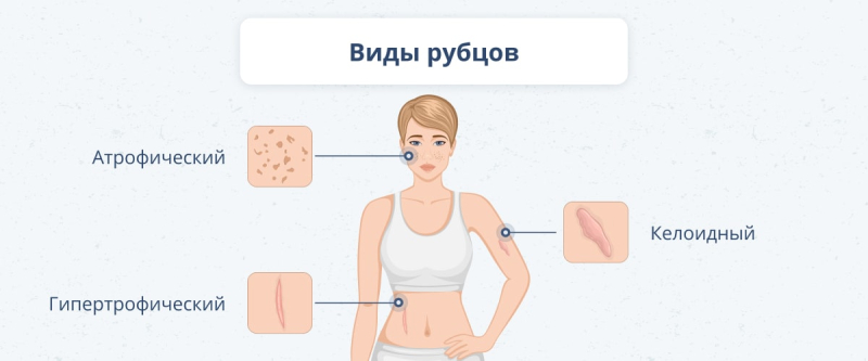 Что делать после ожога: лечение кожи и средства для заживления ран