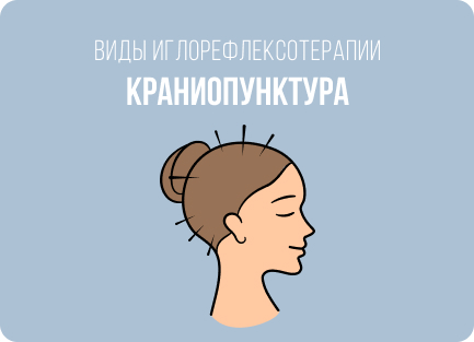 Что и как лечат с помощью иглоукалывания: болезни, показания и противопоказания