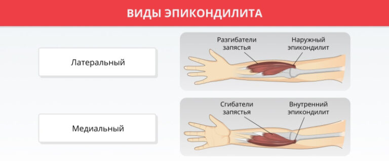 Эпикондилит локтевого сустава: симптомы и методики лечения