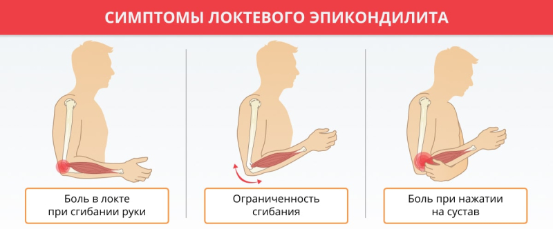 Эпикондилит локтевого сустава: симптомы и методики лечения