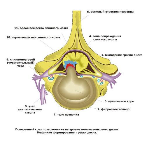 Лечение головной боли при остеохондрозе