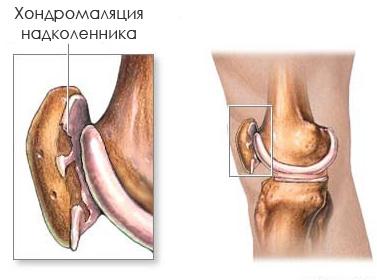 хондромаляция наколенника