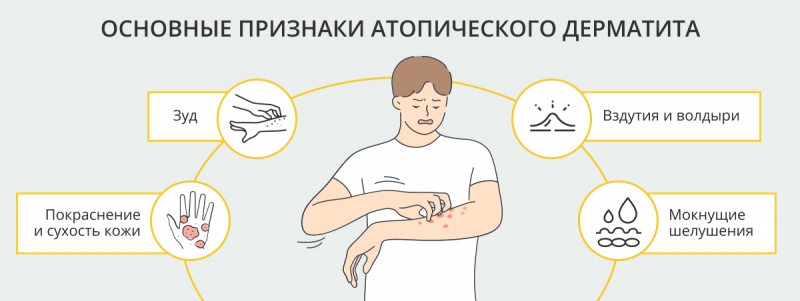 Как проявляется атопический дерматит и как его лечат decoding=