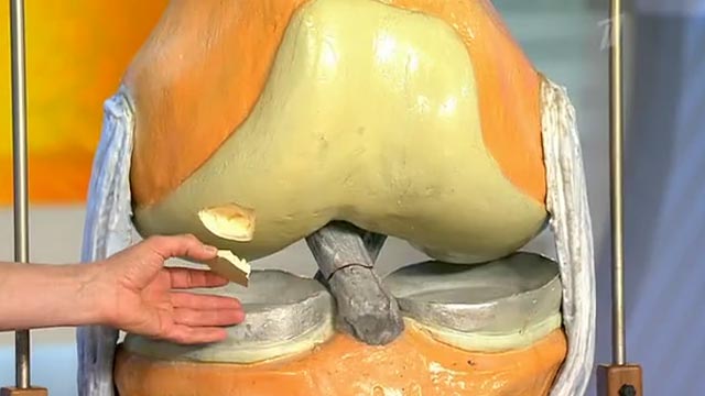 Болезнь Кенига коленного сустава