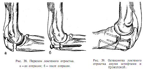 лечение перелома локтя