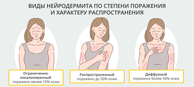 Нейродермит: симптомы, признаки, методы лечения и препараты