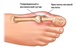 подагра на ноге