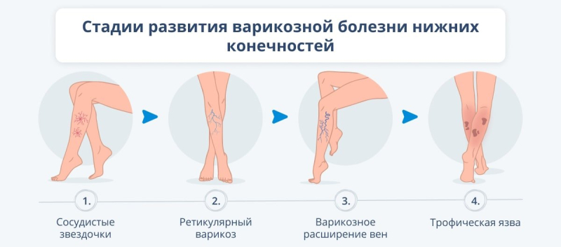 Причины, симптомы, лечение и профилактика варикозной болезни