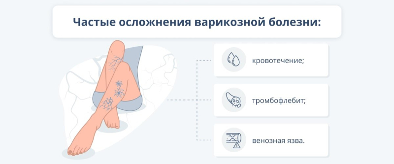 Причины, симптомы, лечение и профилактика варикозной болезни