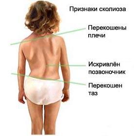 сколиоз у детей