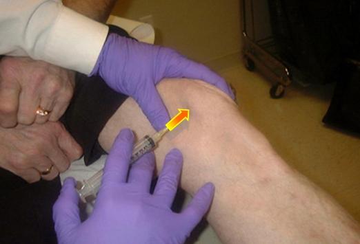 введение лекарств в колено введение лекарств в колено