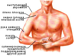вывих плеча