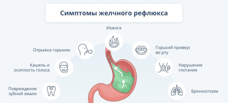 Заброс желчи в пищевод: когда норма становится патологией