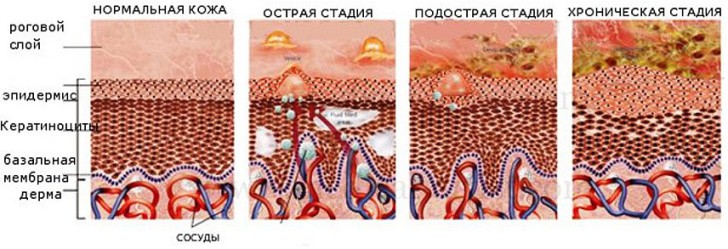 Стадии экземы