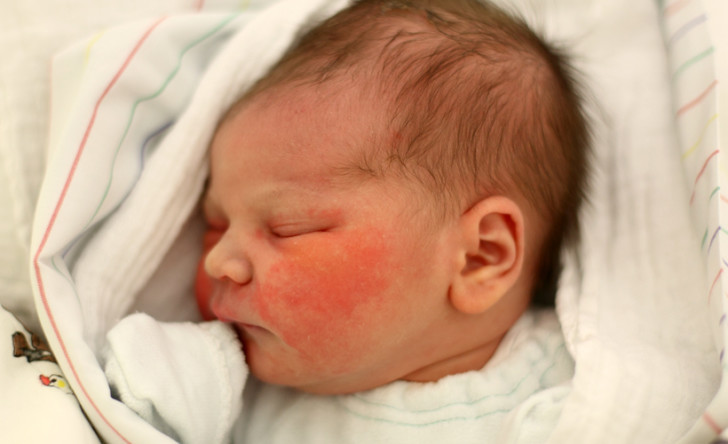 Эритема новорожденного Эритема новорожденного