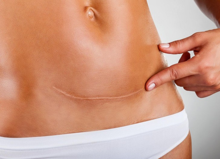 Кесарево сечение Кесарево сечение