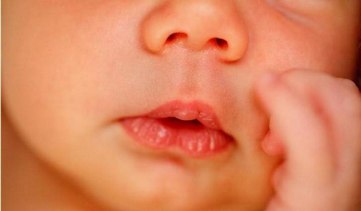 Мозоль на верхней губе грудничка