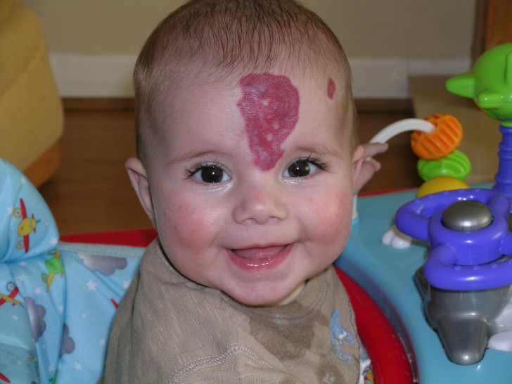 Огненный невус Огненный невус