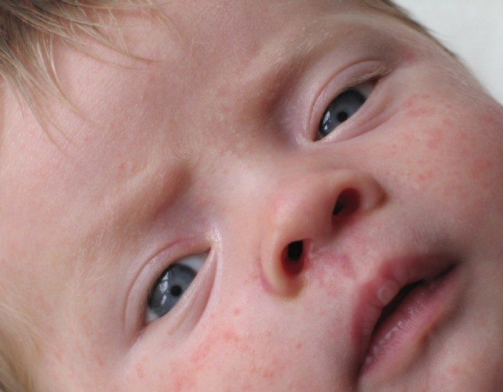 Крапивница у ребенка Крапивница у ребенка