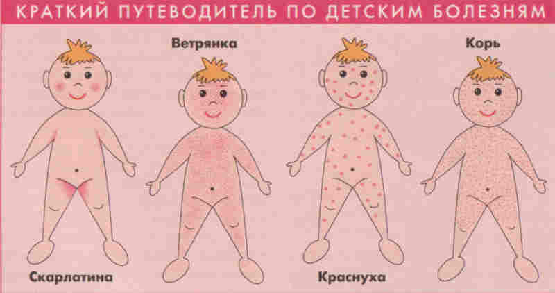 Сыпь при инфекционных заболеваниях