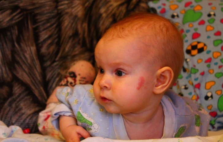 Невус у новорожденного Невус у новорожденного