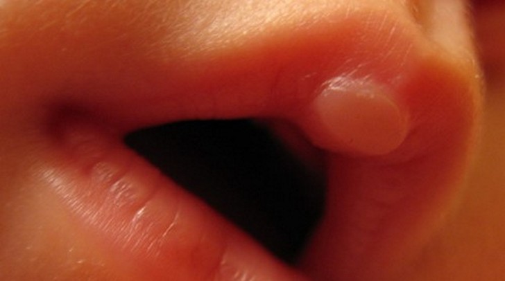 "Молочная мозоль"