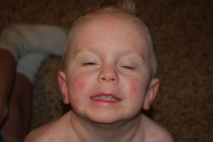 Сыпь при скарлатине Сыпь при скарлатине