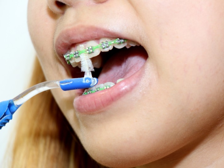 Чистка зубов ершиком Чистка зубов ершиком