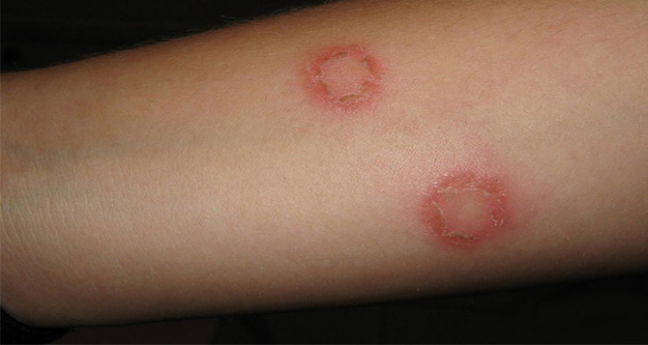 Фото отрубевидного лишая на руке