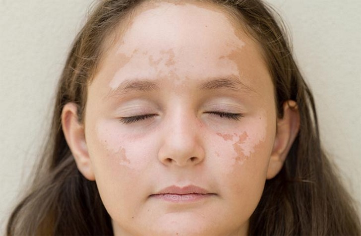 Белые пятна на коже у ребенка - повод в обязательном порядке обратиться к дерматологу