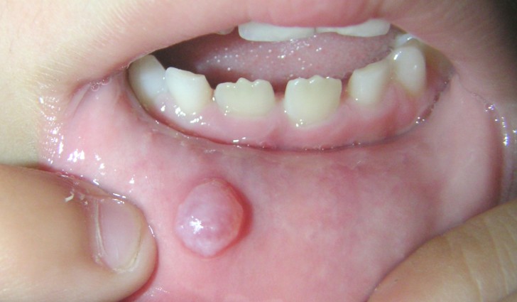 Герпесный стоматит у грудничка