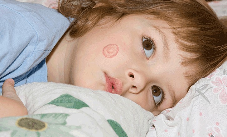 Разноцветный лишай на лице у детей