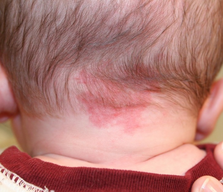 Красные пятна Красные пятна