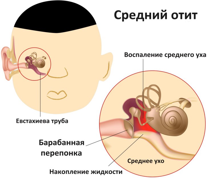 ostryy-sredniy-otit