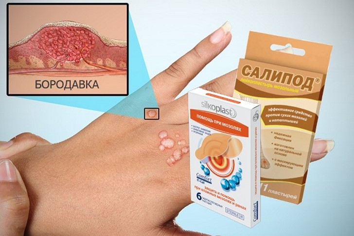 poloski-dlya-udaleniya-papillomi